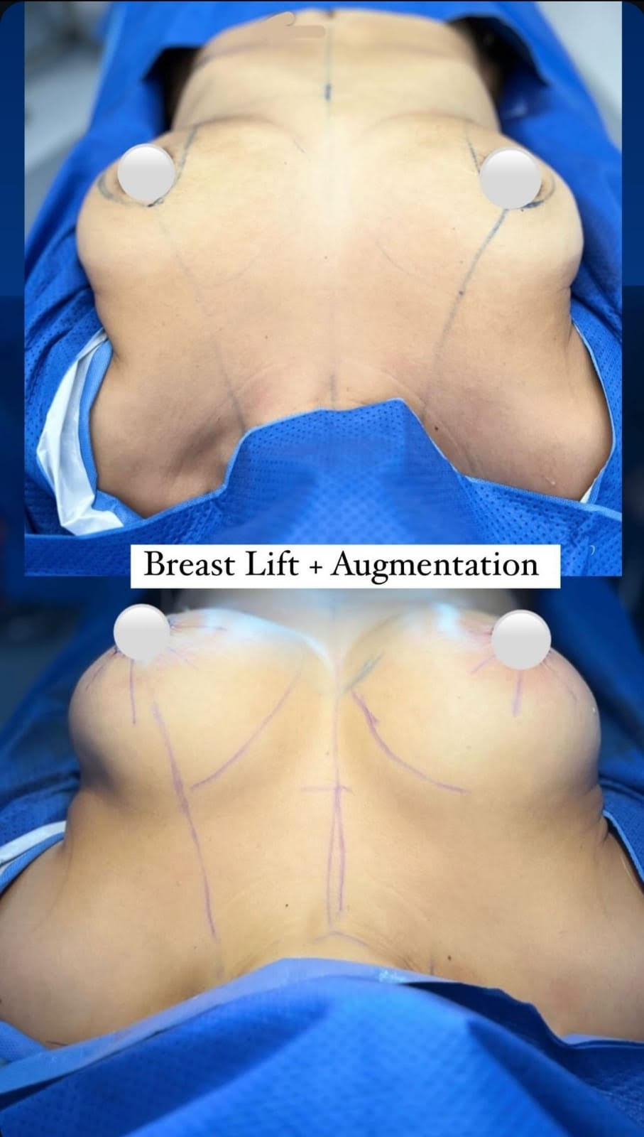 breastlift-augmentation