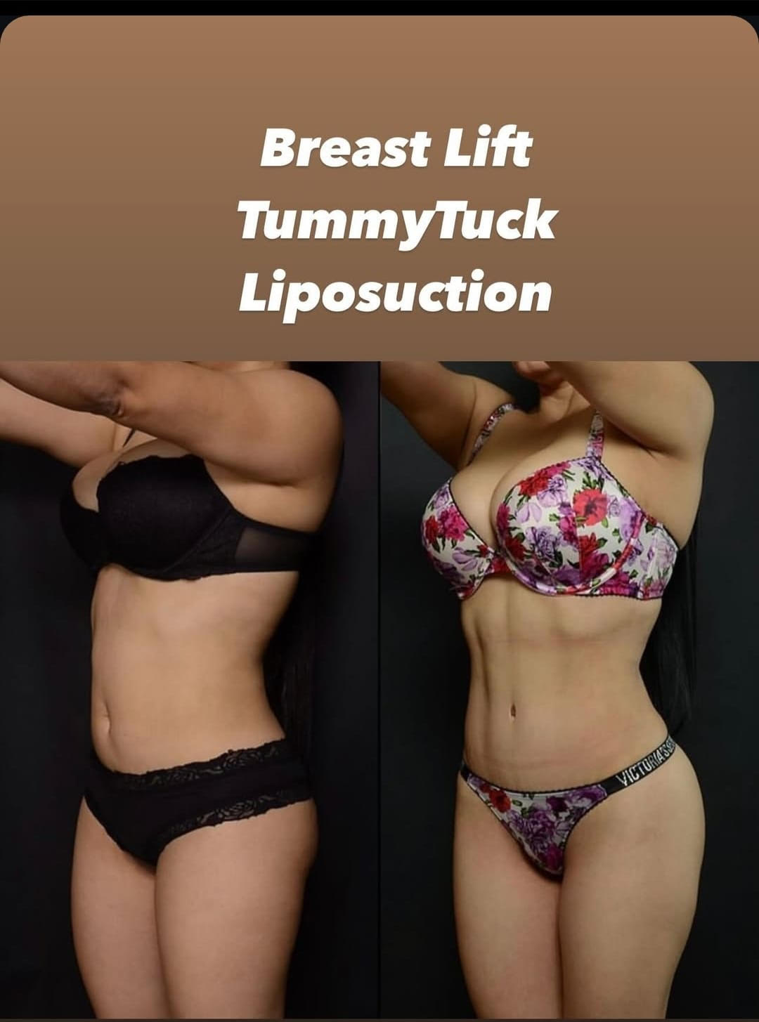 breastlift-tummytuck-liposuction