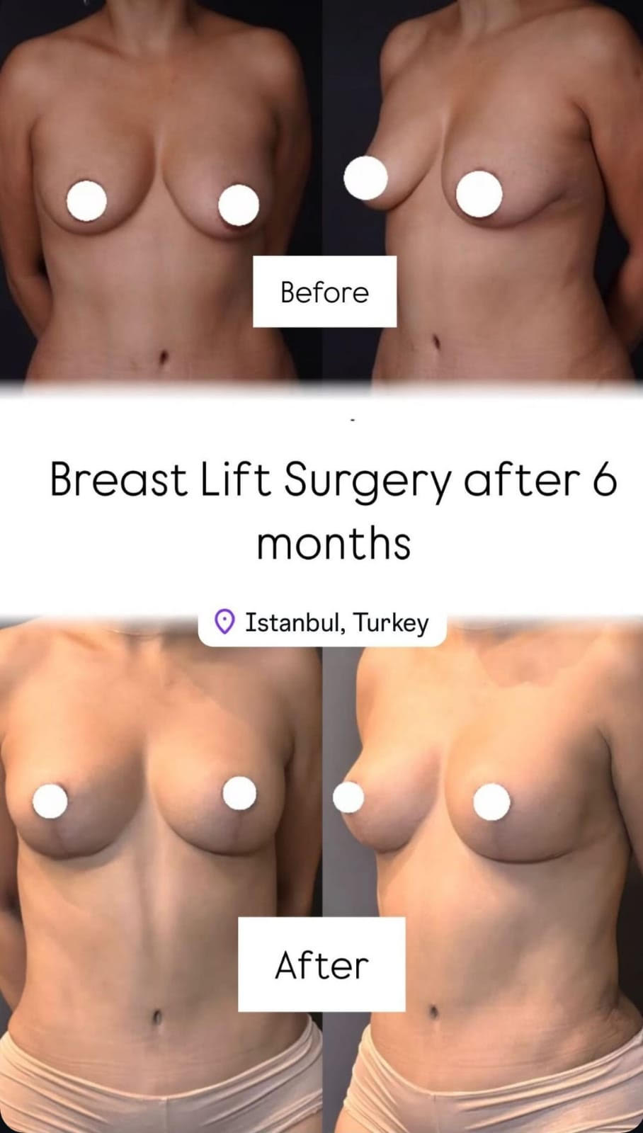 breastlift