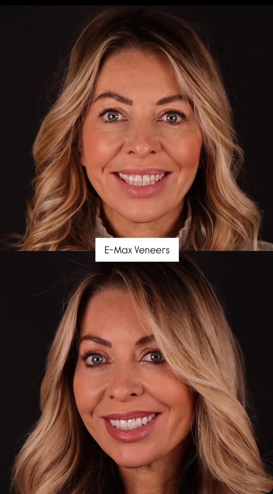 emaxveneers