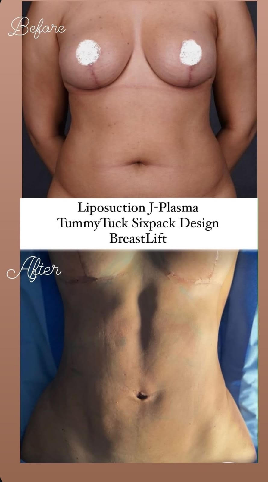 liposuction-jplasma-tummytuck-breastlift