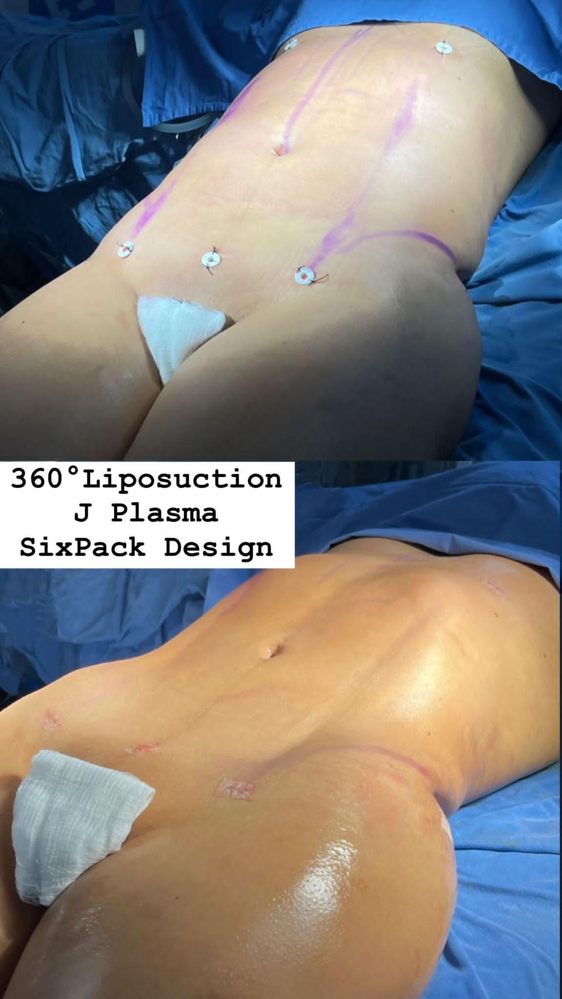liposuction-jplasma