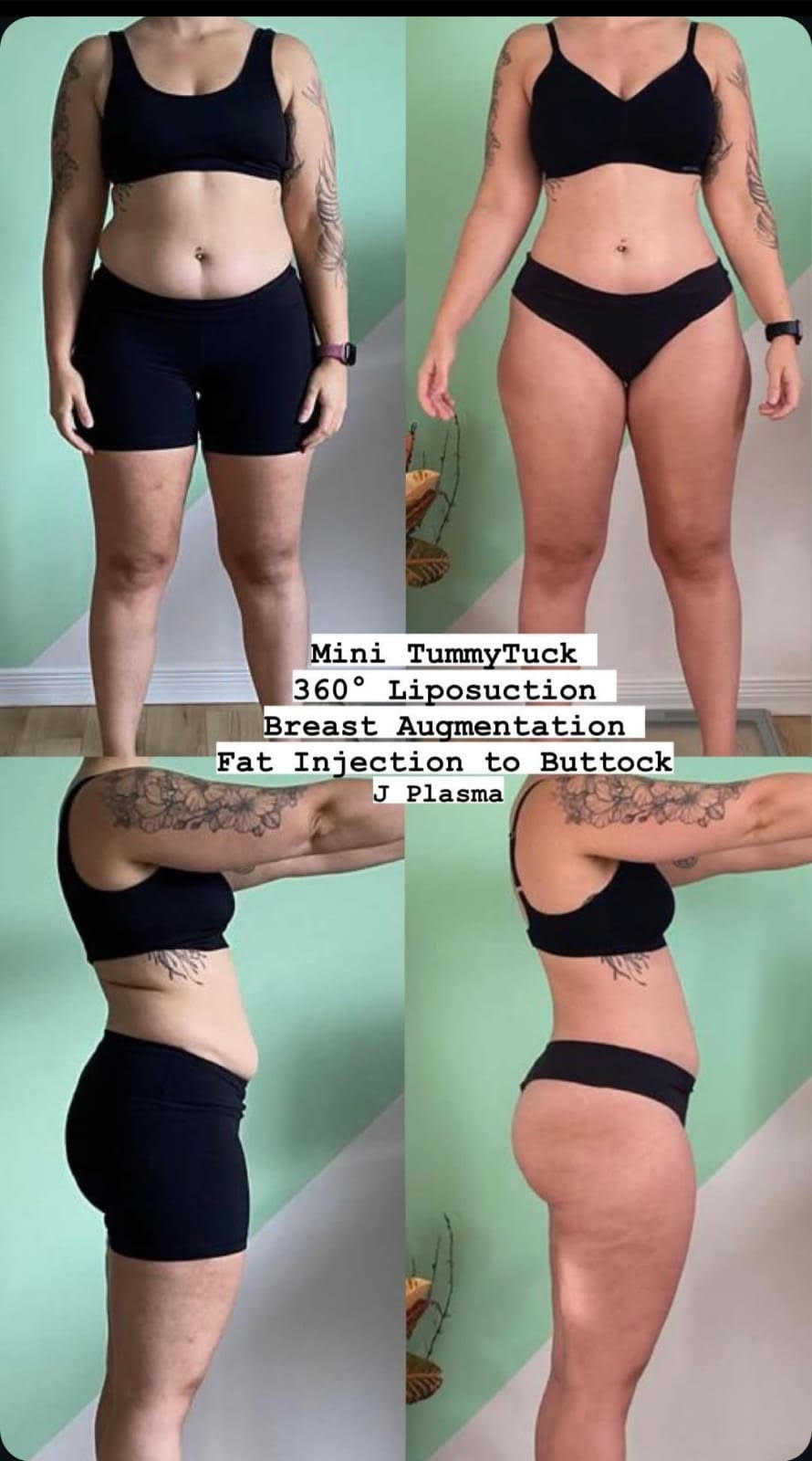 tummytuck-liposuction-breastaugmentation-fatinjection-jplasma