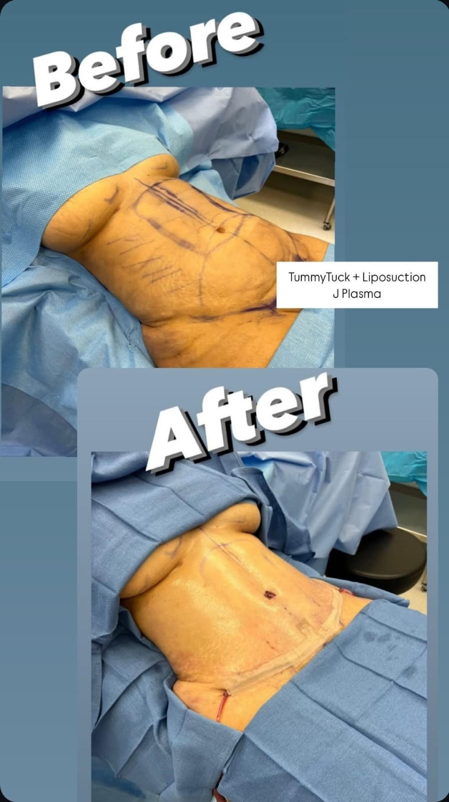 tummytuck-liposuction-jplasma