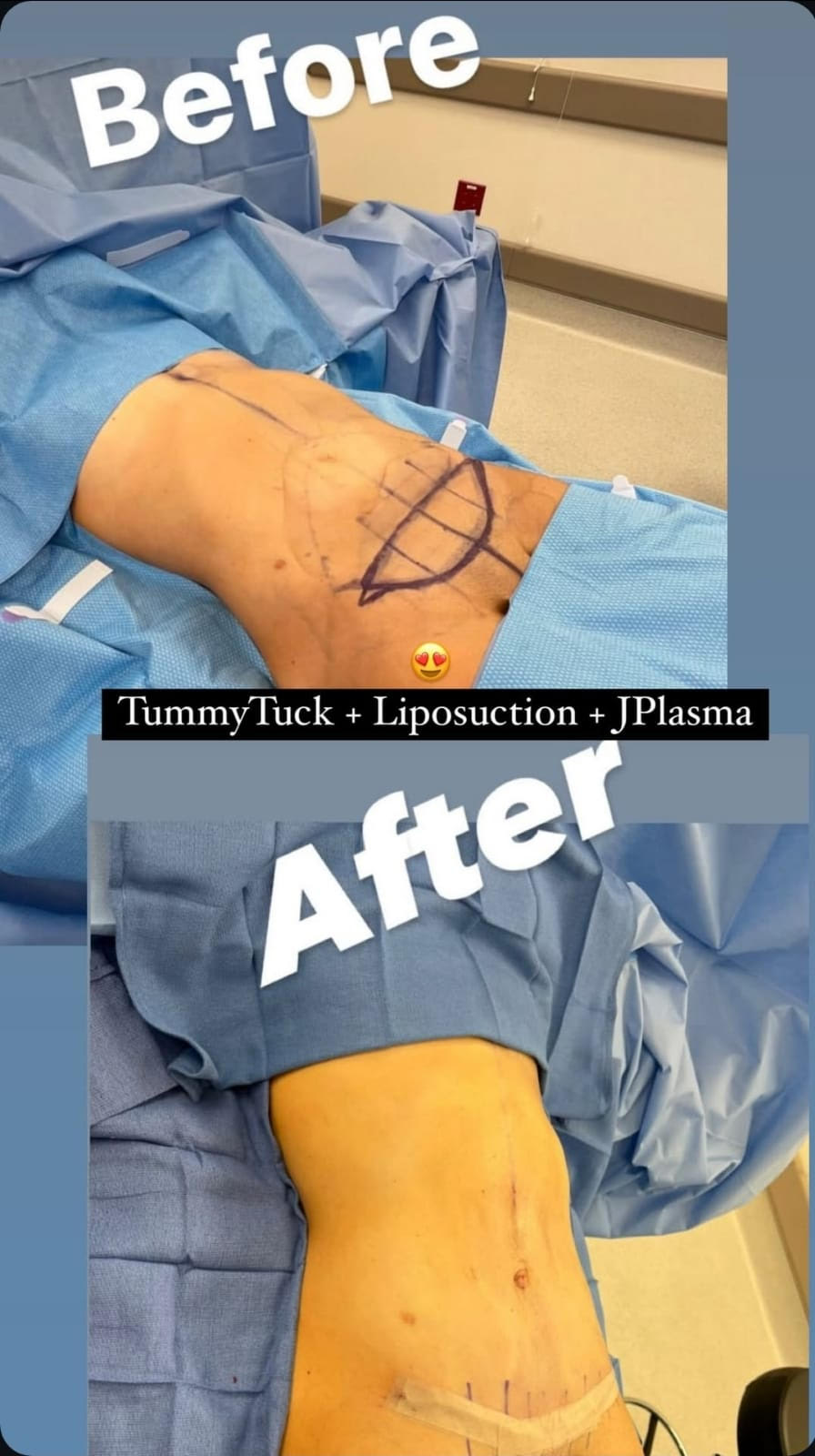 tummytuck-liposuction-jplasma2
